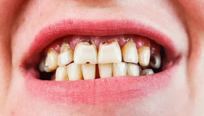periodontal-surgeries-grafting-procedures-serivice-img